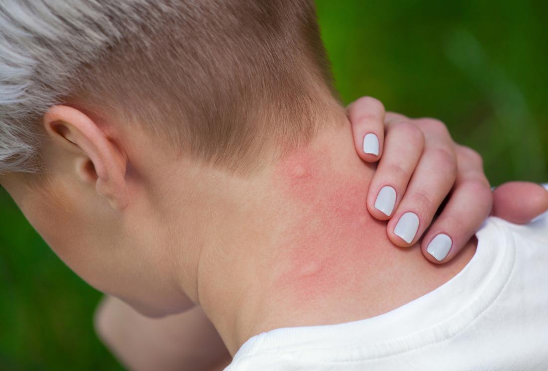 allergic reaction on back of neck