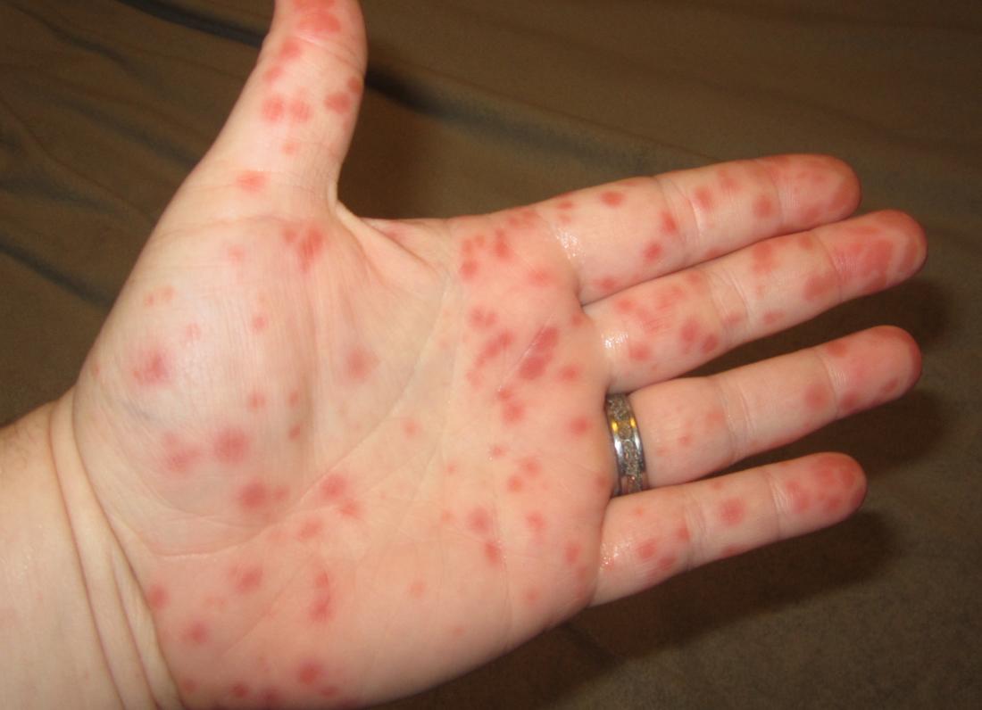 Allergic reaction rash on hands and feet