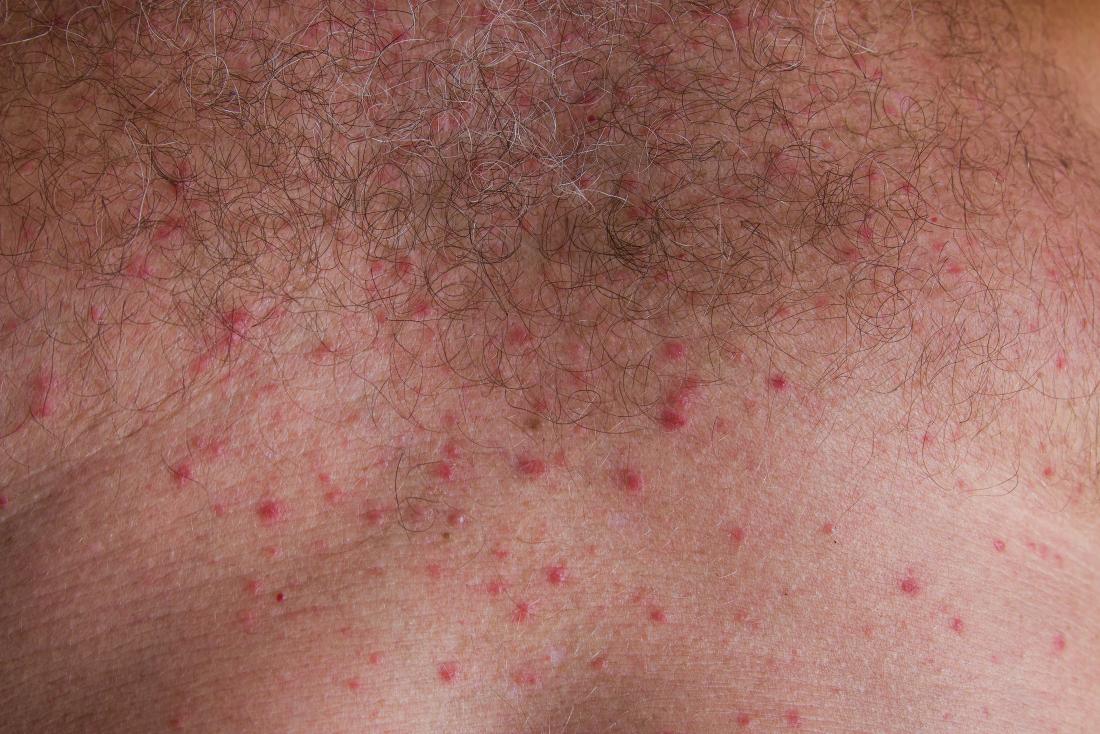 8 Types Of Itchy Rash