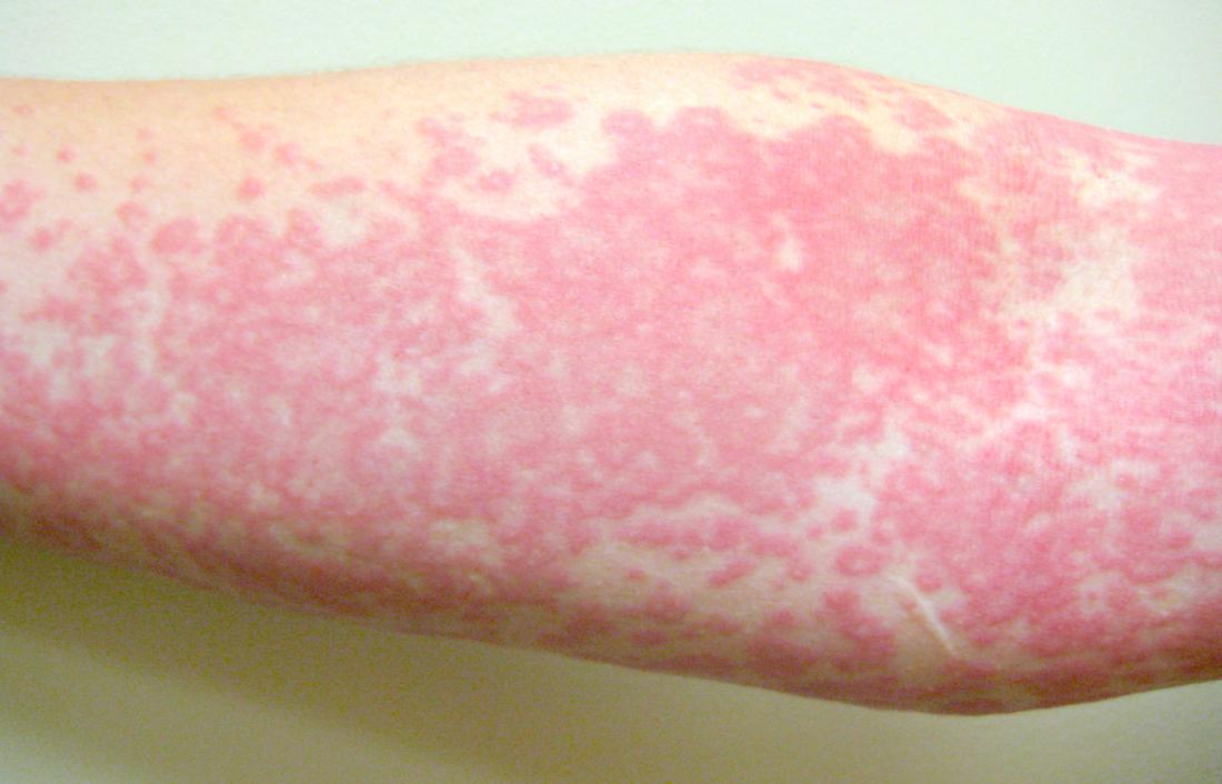 8 types of itchy rash