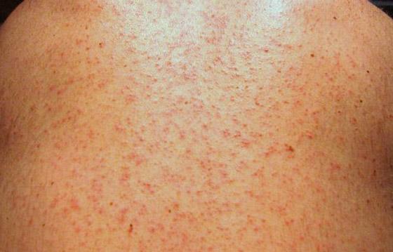 Image result for Itchy rash: 8 types