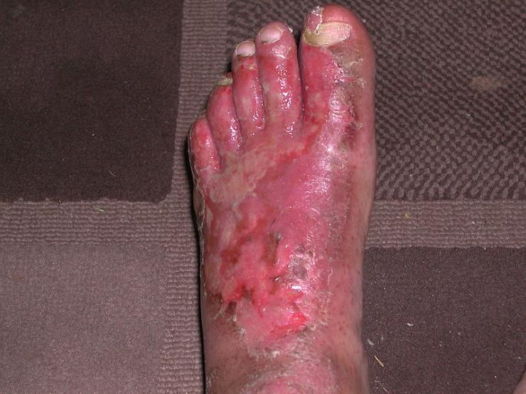 severe athlete s foot top of foot