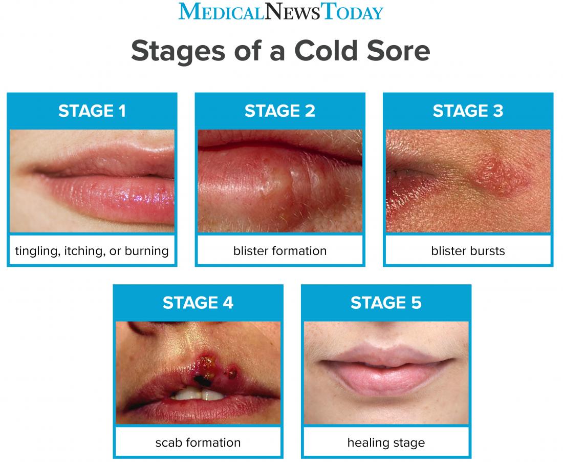 Cold sore stages photos