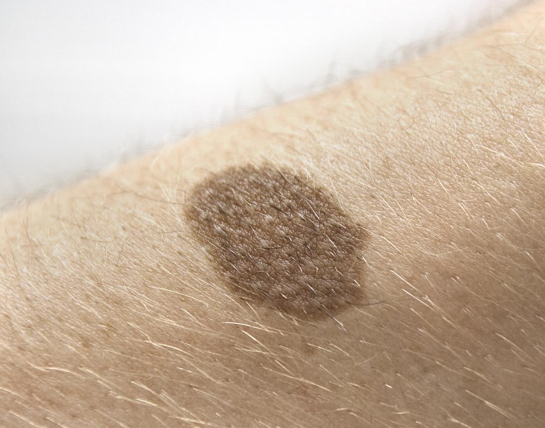 a large Birthmark on a patch of skin