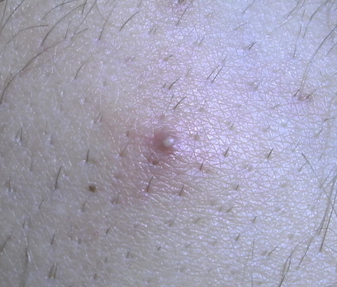 an ingrown hair on the skin that might look similar on the penile shaft