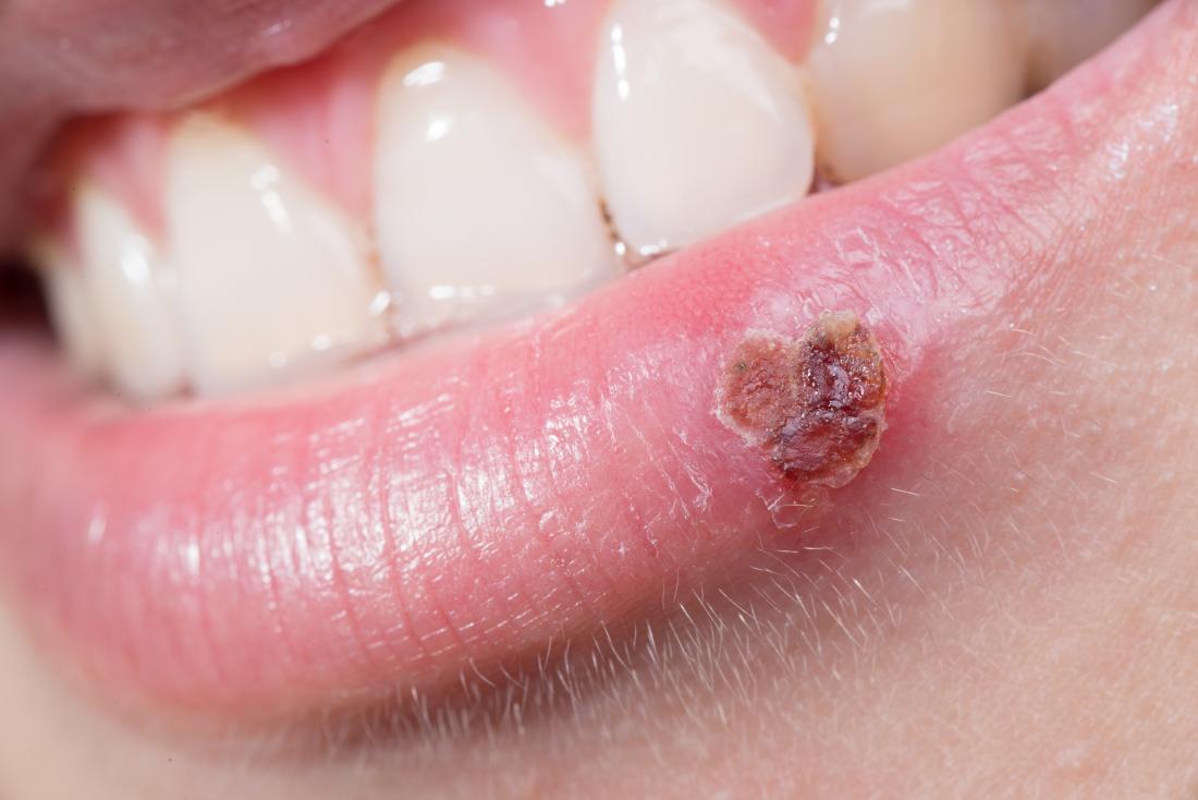 Cold sore on the side of the lip