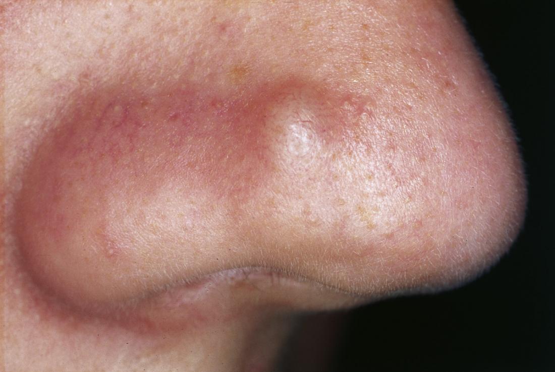 papules on a persons nose. Image credit: M. Sand, D. Sand, C. Thrandorf, V. Paech, P. Altmeyer, F. G. Bechara, 2010.
