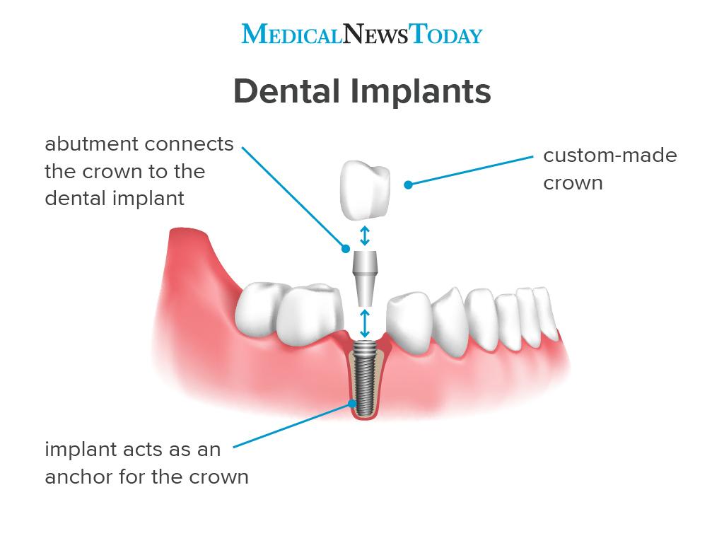 Wisdom Tooth Cavity