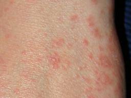 Scabies Rash On Legs Pictures