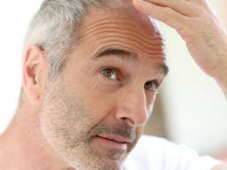 Receding Hairline Treatment Stages And Causes