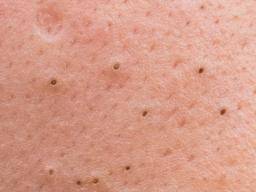 Blackheads: Facts, causes, and treatment