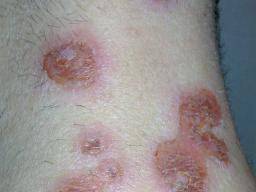 Shingles untreated