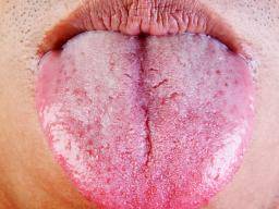 candidiasis tongue