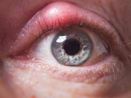 Eyelid Bump Types Causes And Treatment