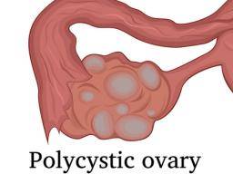 Polycystic ovary syndrome (PCOS): Causes, symptoms, and ...