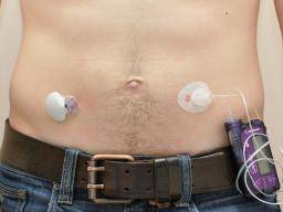 Artificial Pancreas Better Than Pump For Managing Type 1 Diabetes