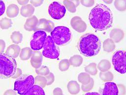 Fasting could help treat most common childhood leukemia