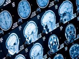 Mri Shows Brain Differences Among Adhd >> Adhd Large Imaging Study Confirms Differences In Several Mri Shows Brain Differences Among Adhd >> Adhd Large Imaging Study Confirms Differences In Several