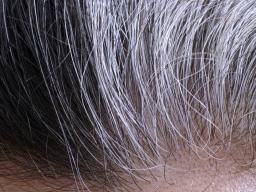 Study provides new insights into male pattern baldness