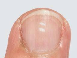 White Spots On Nails Causes Prevention And Treatment