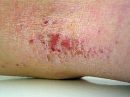 Scientists find genetic underpinnings for eczema