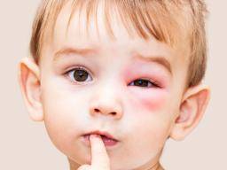 Yellow jacket stings: Treatment, allergic reaction, prevention