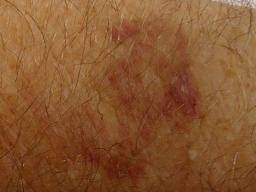 Blood clot or bruise: Differences, symptoms, and when to see a doctor