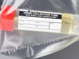Glucose Urine Test Color Chart