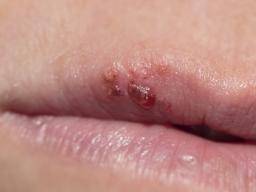 Herpes Gladiatorum Symptoms Causes And Treatment