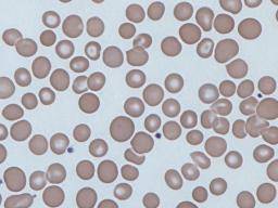 Anisocytosis: Causes, symptoms, and treatment
