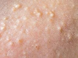 White spots on the skin: Possible causes and treatments