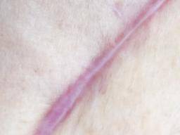How To Get Rid Of Keloids Home Remedies Treatment And Tips