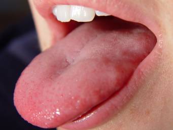 Phentermine side effects sore tongue