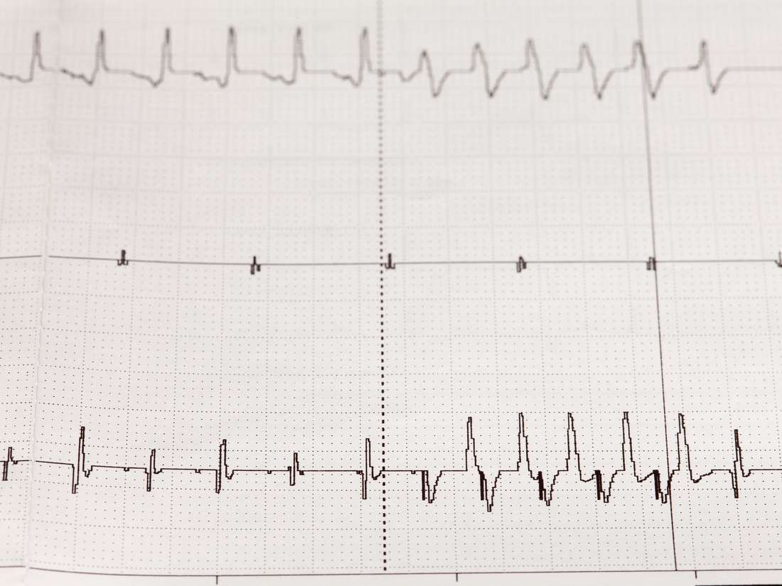 Types Of Arrhythmia Chart