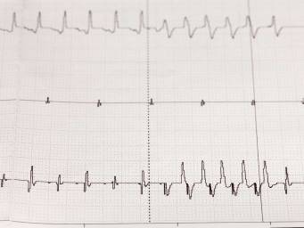 Heart rate: What is a normal heart rate?