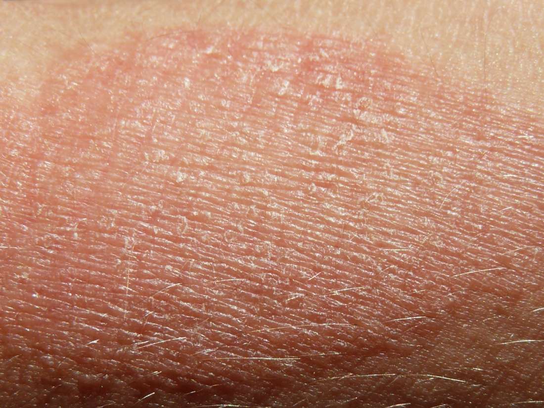 Eczema Symptoms Treatment And Causes