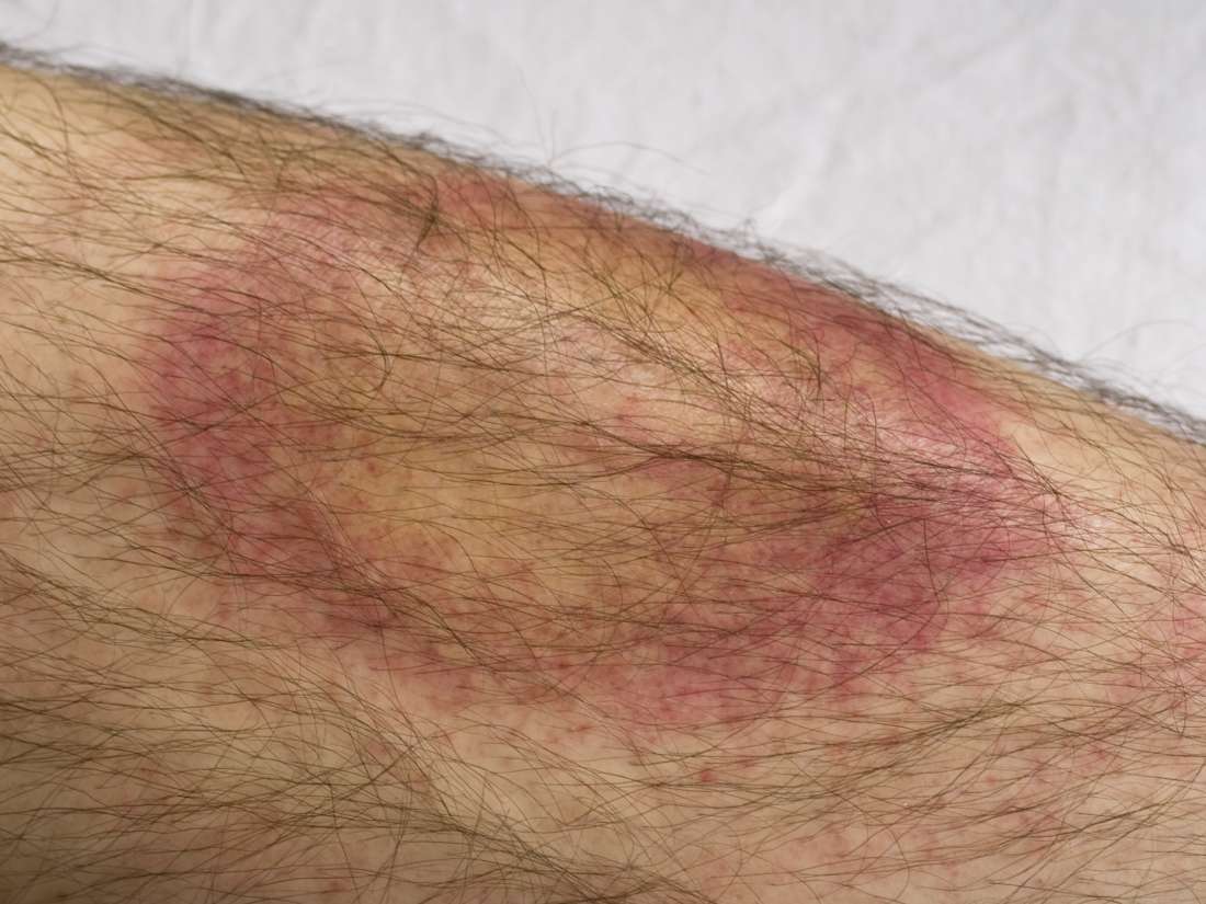 Lyme Disease Symptoms Transmission And Treatment