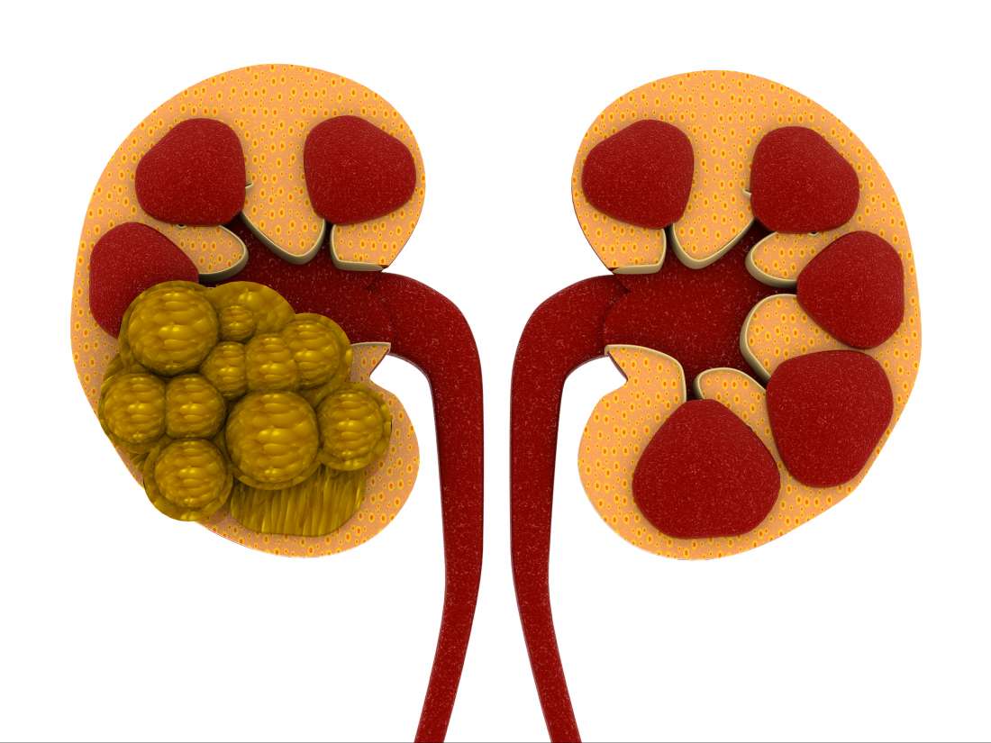 Kidney stones Causes, symptoms, and treatment