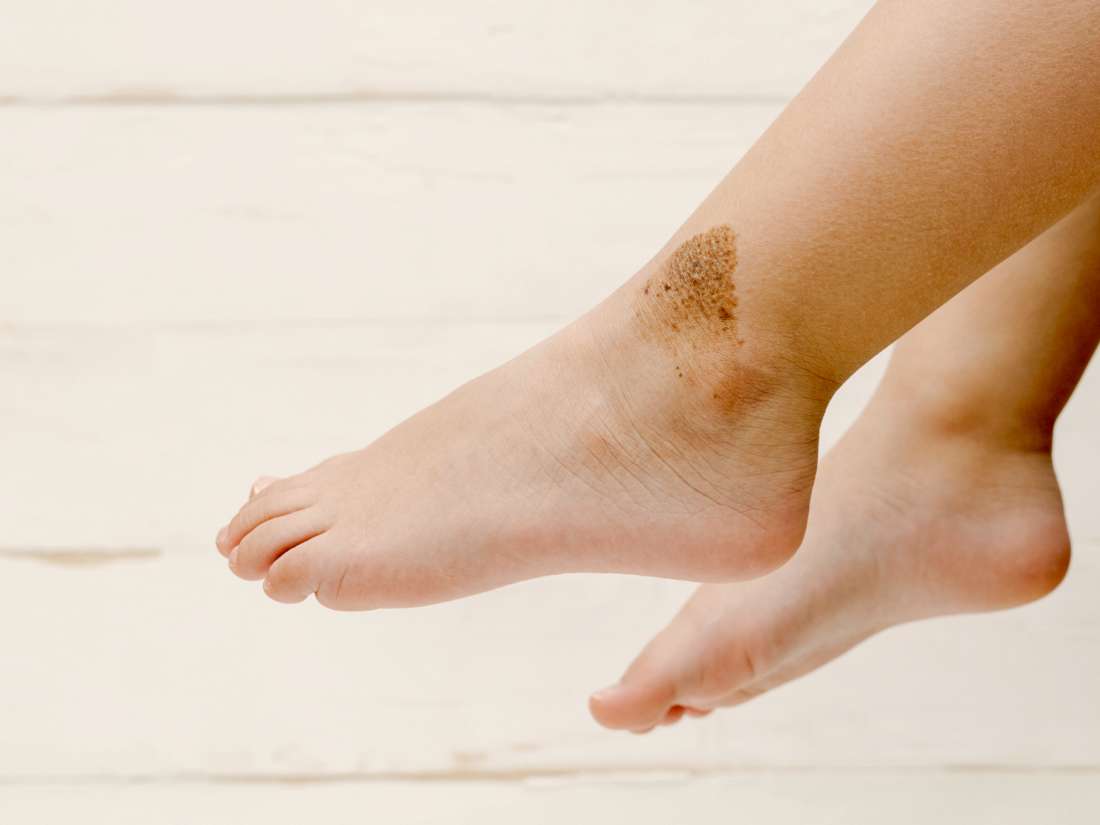 birthmarks-causes-types-and-treatments