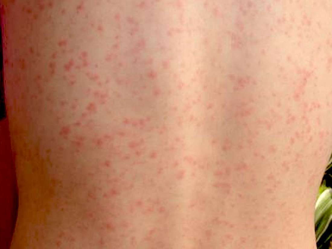 When Do Babies Get Scarlet Fever Vaccine