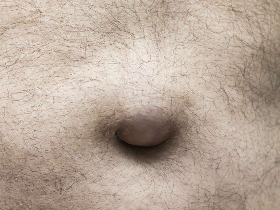 Umbilical Hernia Causes Symptoms And Treatments