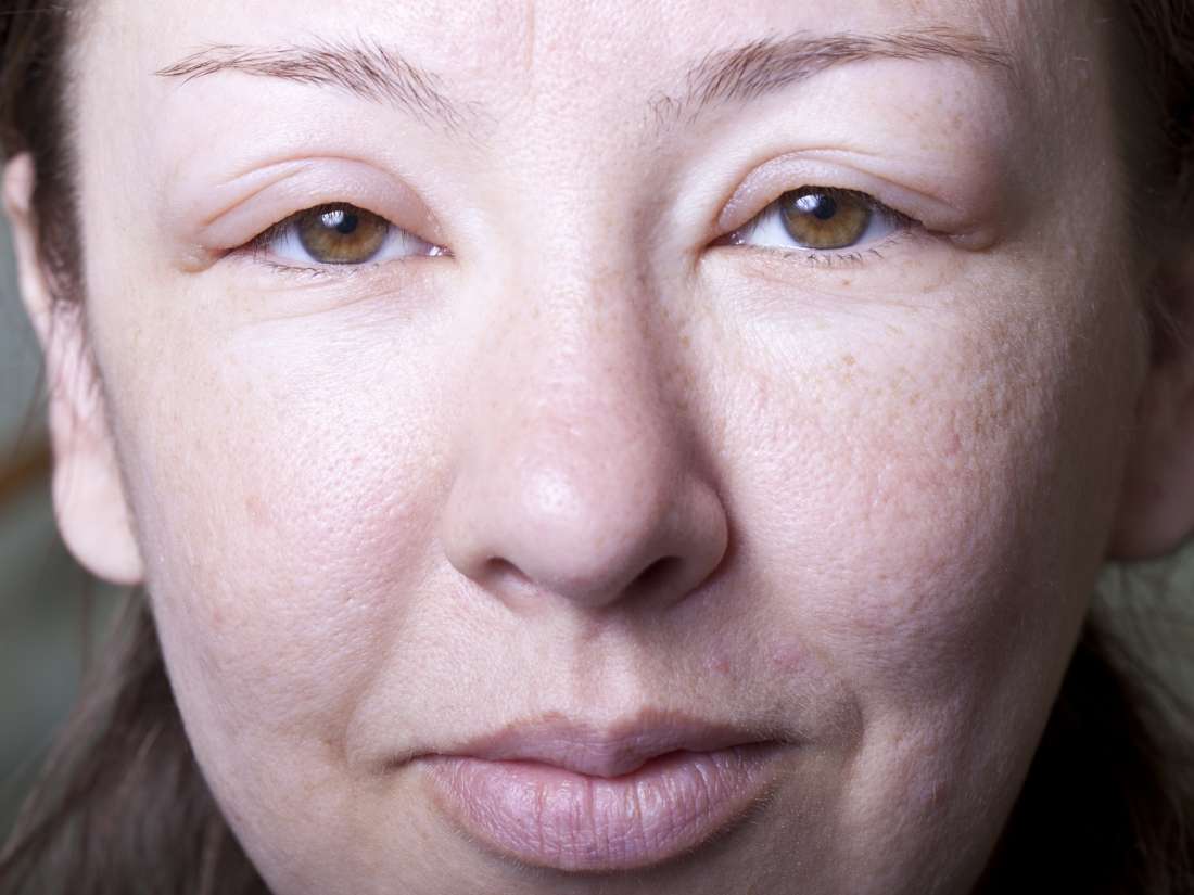 Angioedema: Treatments, types, and symptoms