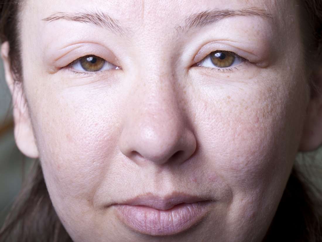 Does Sinus Infection Cause Swelling Under Eyes