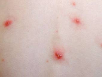 Is it shingles? Symptoms, vs. other conditions, and causes