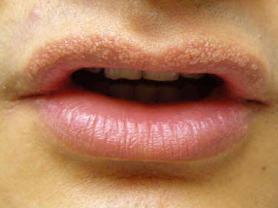 Rash On Lips Pictures - PictureMeta