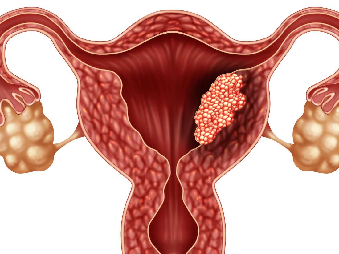 What Is Stage Ivb Endometrial Cancer