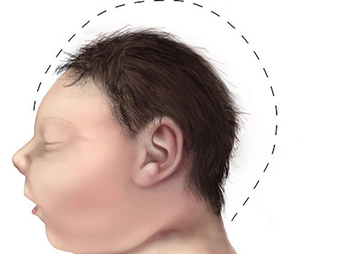 Microcephaly: Causes, symptoms, and treatment