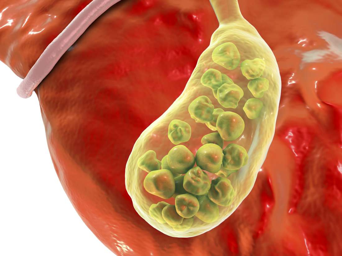 Can Gallbladder Sludge Cause Enlarged Liver