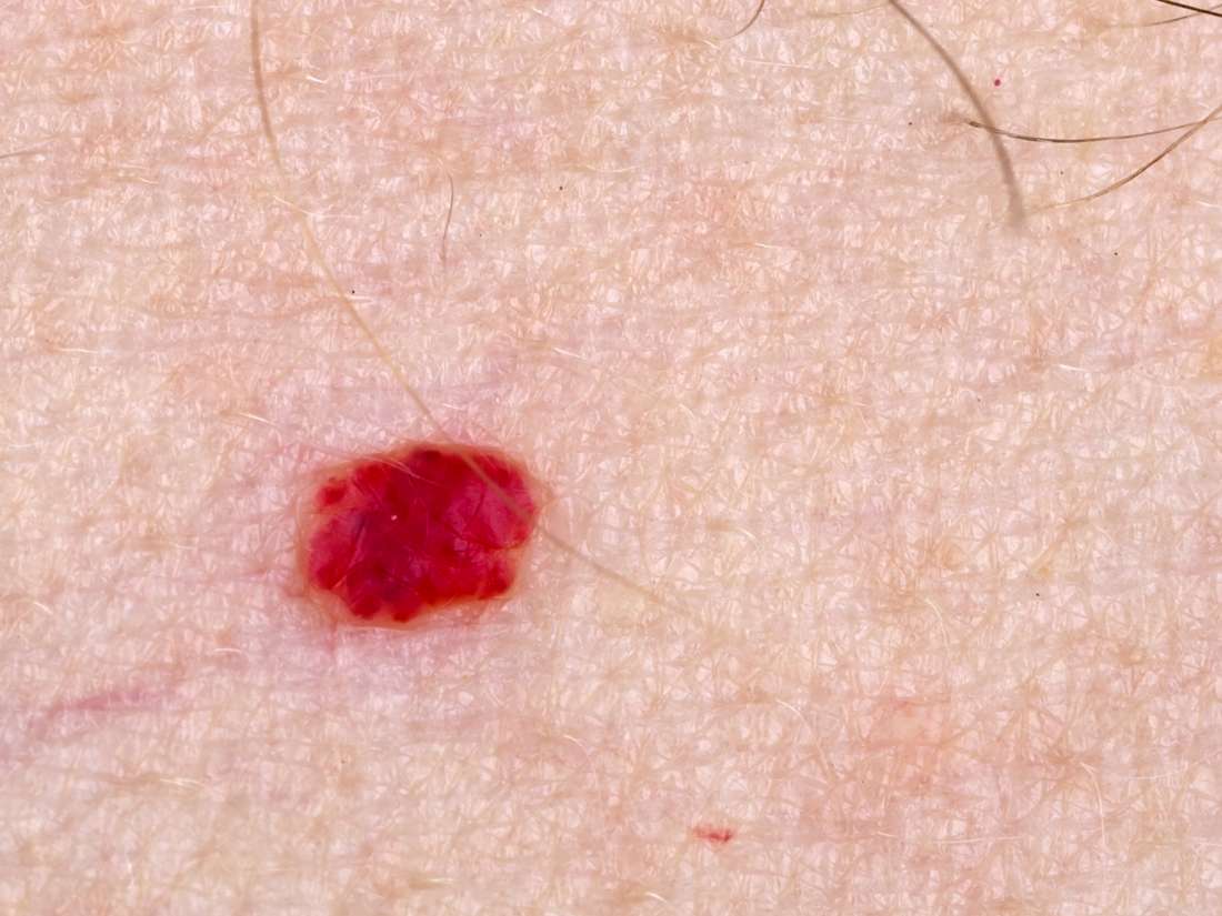 Red Spots On Arm While Pregnant at Donna Anderson blog