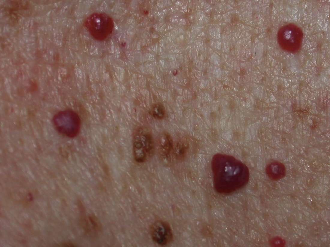 What Does A Cherry Angioma Look Like At Lela Peck Blog